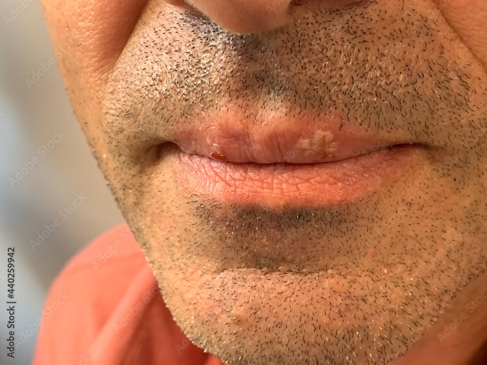 Obraz premium Herpes on the lips of a man close-up.