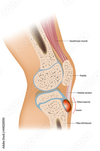 Osgood Schlatter disease or OSD is inflammation of the patellar ligament at the tibial tuberosity photo