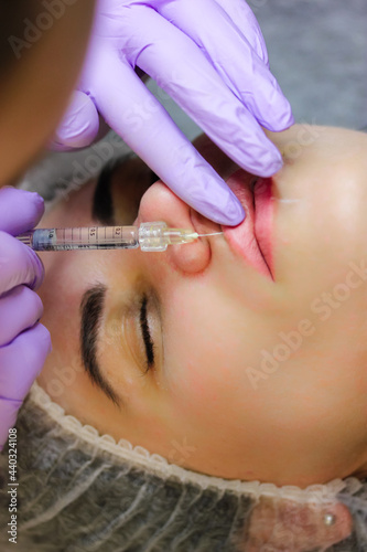 A cosmetologist injects a hyaluronic acid-based filler into the patient s lips. The process of lip augmentation in a young beautiful woman. A nurse is wearing purple rubber gloves. Beauty injections.
