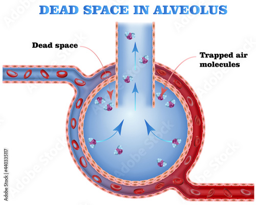 Dead space in alveolus during gas exhange, artifitial lung ventilation, medical vector illustration photo