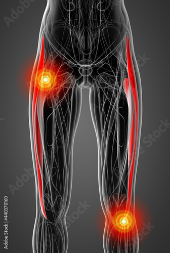 medical  illustration of the  tensor fascia lata