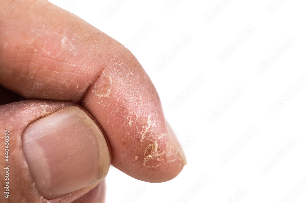 Closeup of painful inflammed damaged dry skin on the finger Closeup of painful inflammed damaged dry skin on the finger