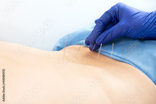 Close up of hand of doctor with blue latex gloves inserting acupuncture needle on back.