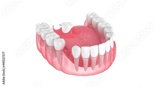 Jaw with removable partial denture isolated over white background