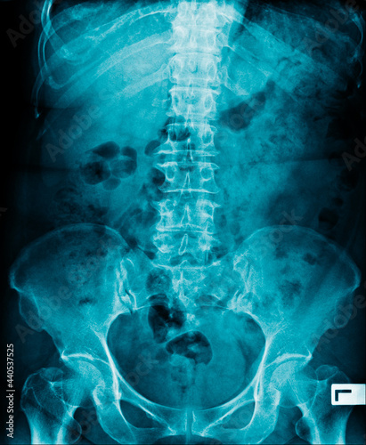 x-ray image of human abdomen, picture of human spine and pelvic bone show degenerative change of spine, low back pain and refer pain to lower limb photo