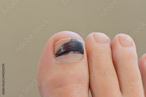 Close up of a big toe with a subungual  hematoma. photo