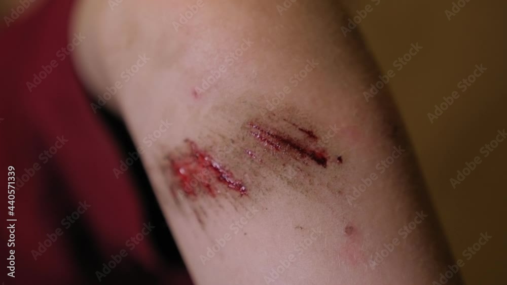 Close-up of a scratch with blood on the hand of a small child.