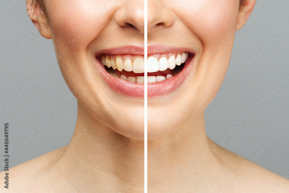 Obraz premium woman teeth before and after whitening. Over white background. Dental clinic patient. Image symbolizes oral care dentistry, stomatology.