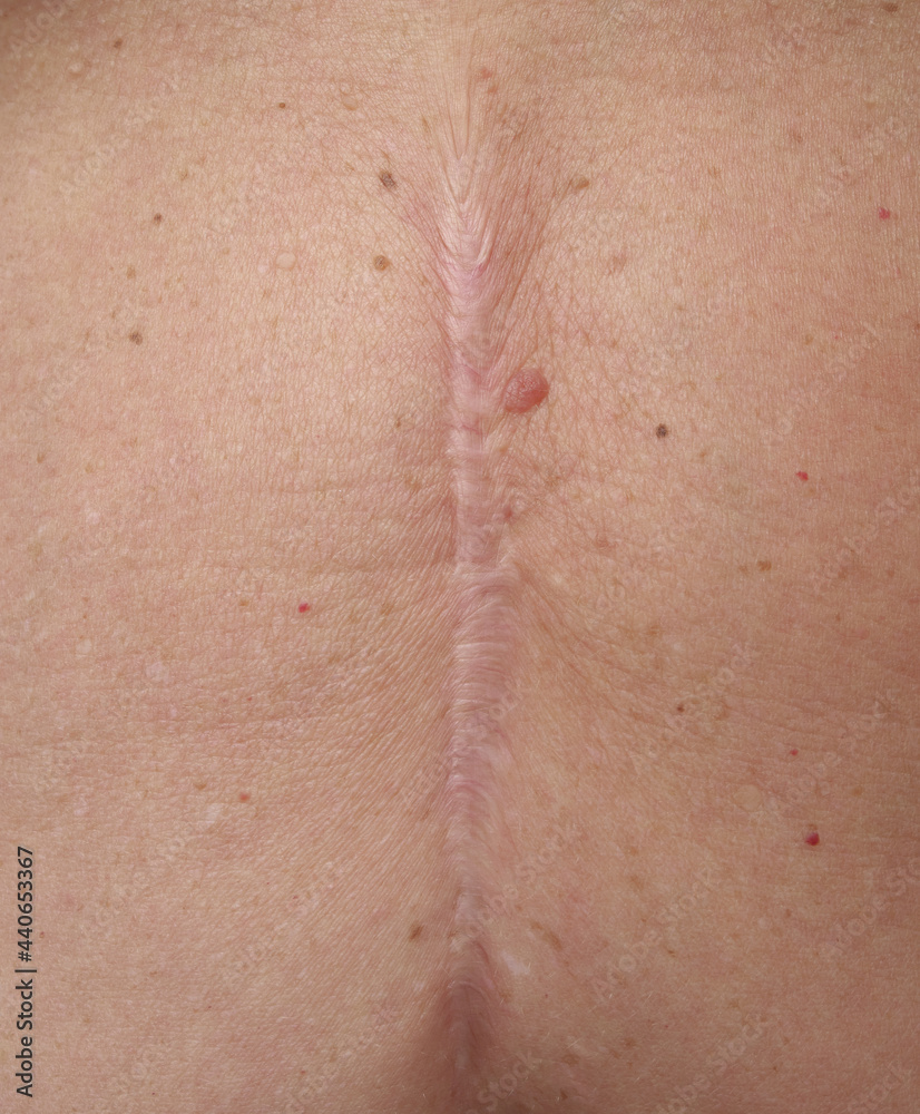 Fototapeta premium Scar on the abdomen after surgery 14 years later