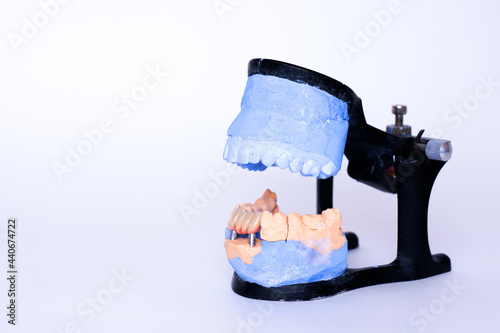 Veneers and crowns on gypsum dental artificial jaw on grey background. Working demountable plaster model of teeth. White front teeth veneers on diagnostic model. Concept of aesthetic dentistry
