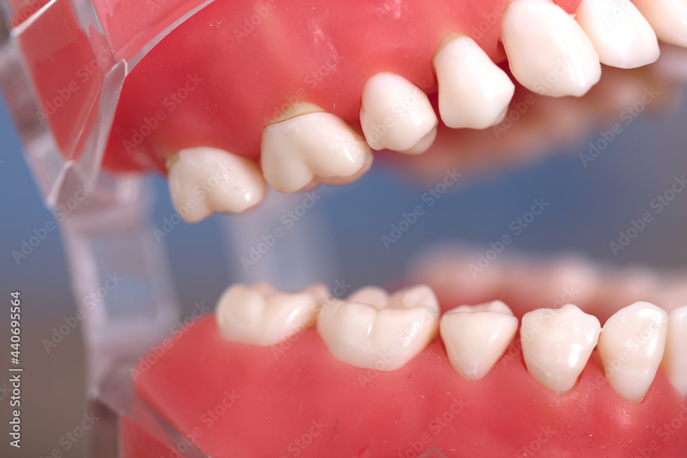 Close-up of teeth in oral model