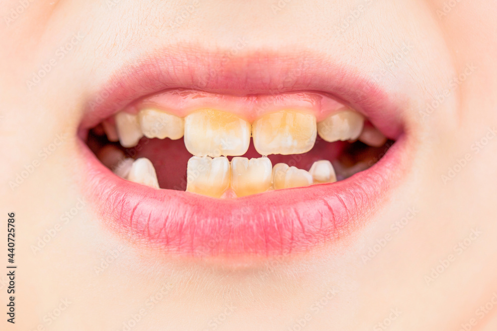Bad teeth child. Portrait boy with bad teeth. Child smile and show her