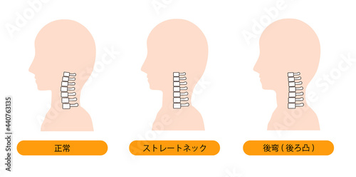 ストレートネック・頸椎後湾症・正常な首の骨のイメージ