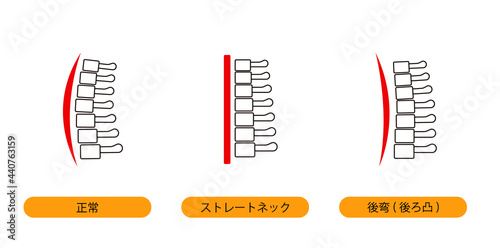 ストレートネック・頸椎後湾症・正常な首の骨のイメージ