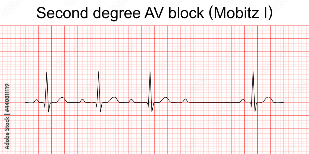 Electrocardiogram show second degree AV block (Mobitz I) or wenckebach  pattern. ECG. EKG. Vital sign. Heart beat. Life line. Medical healthcare  symbol. Stock-Vektorgrafik | Adobe Stock