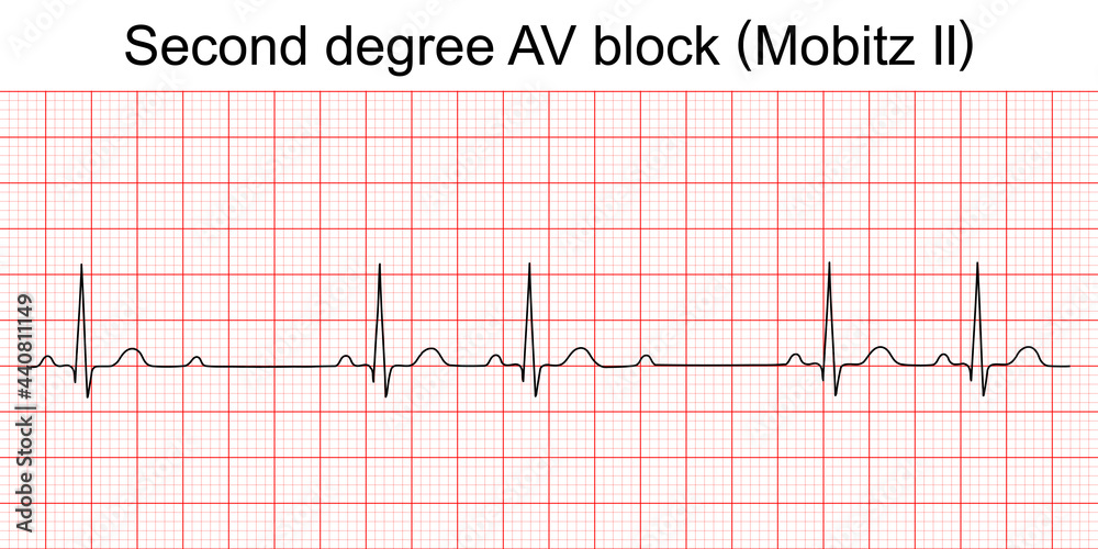 Electrocardiogram show second degree AV block (Mobitz II) pattern. ECG. EKG. Vital sign. Heart