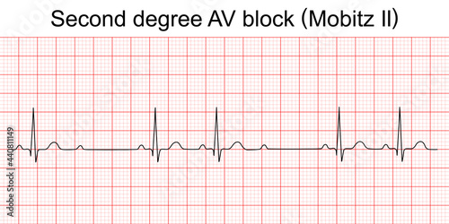 Electrocardiogram show second degree AV block (Mobitz II) pattern. ECG. EKG. Vital sign. Heart beat. Life line. Medical healthcare symbol.