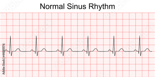 Electrocardiogram show normal heart beat line (Sinus rhythm). ECG. EKG. Vital sign. Medical healthcare symbol. photo