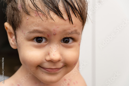 Obraz na plátně Cheerful kid face with ulcers, rash from chickenpox, varicella