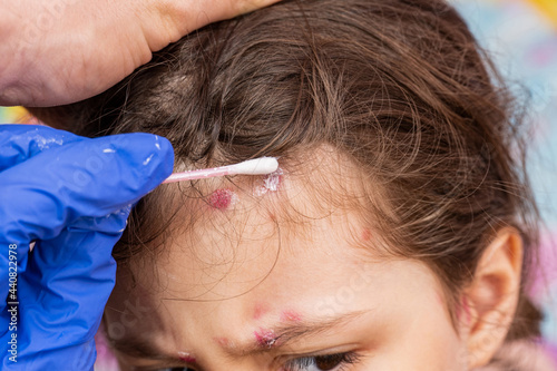 Obraz na plátně treatment of ulcers from chickenpox, varicella with medical cream on child head