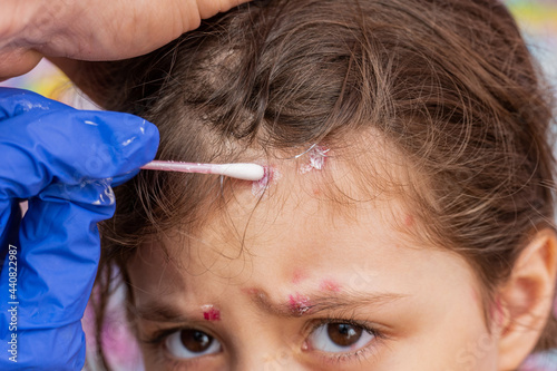 Fotografie treatment of ulcers from chickenpox, varicella with medical cream on child head