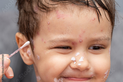 Fotografie treatment of ulcers, rash from chickenpox, varicella on dissatisfied kid face