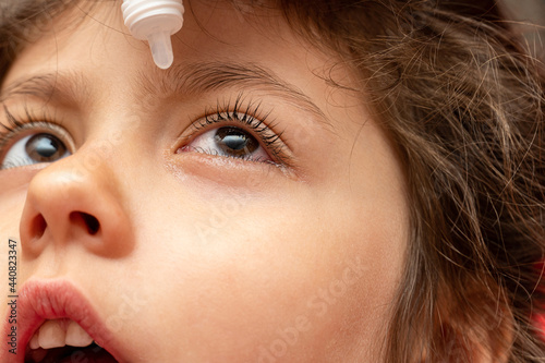 treatment, using therapeutic, medical eye drops for a child with conjunctivitis