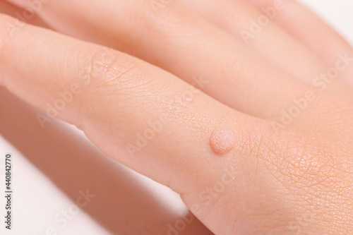 Common wart Verruca vulgaris a flat wart commonly found on the hand of children and adults. They are caused by a type of human papillomavirus HPV.
