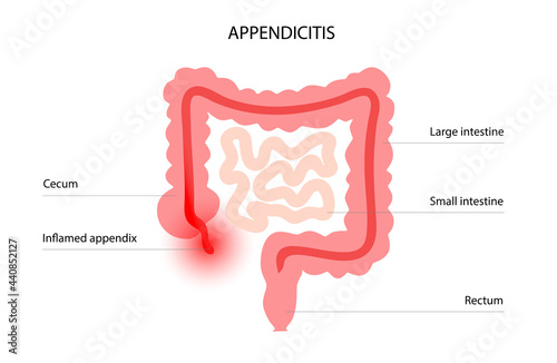 Appendix pain concept