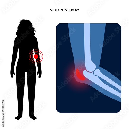 Student elbow bursitis