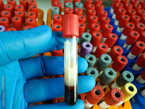 Scientist hold Lipemic blood sample, high Triglyceride contain serum sample. Lipemia in a blood specimen can cause significant interference with obtaining accurate test values photo