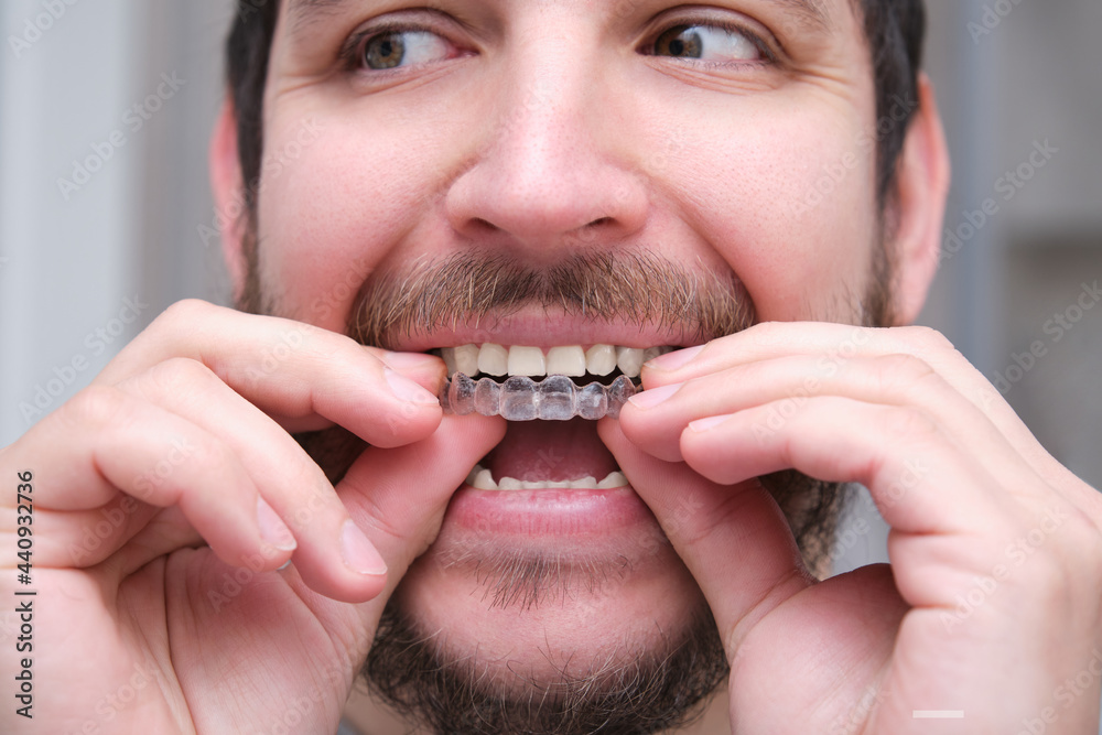 Close up of young latin man putting orthodontic silicone trainer or  invisible braces aligner. Mobile orthodontic appliance for dental correction.  Photos | Adobe Stock