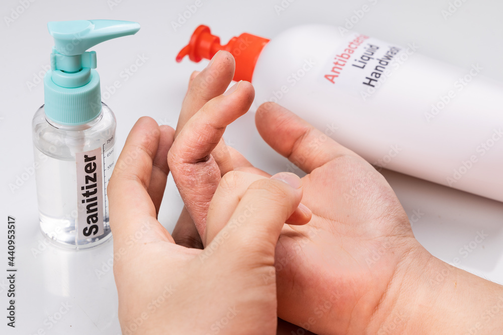 Dry skin on finger with bottle of antibacterial liquid handwash and
