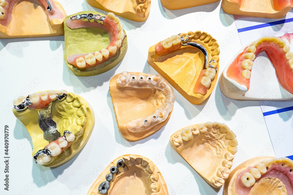 Dental models top view. Jaw models with different problems. Treatment