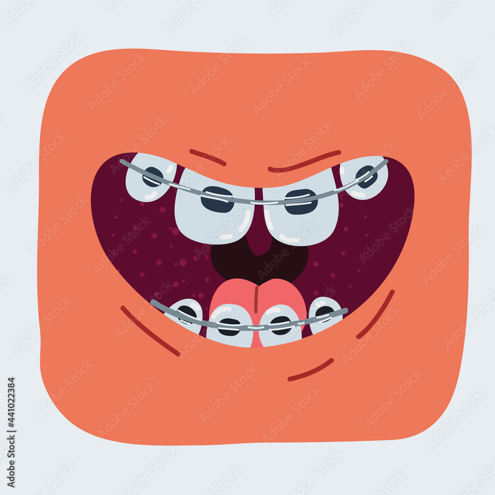 Vector illustration of Braces Corrective Orthodontics, smiling comic mouth with teeth and braces Vector illustration of Braces Corrective Orthodontics, smiling comic mouth with teeth and braces