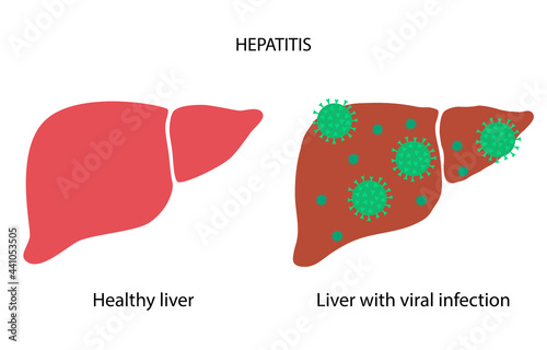 Liver disease concept