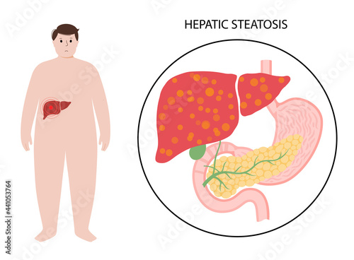 Liver disease concept
