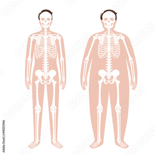 Obese skeleton anatomy