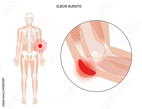 Student elbow bursitis