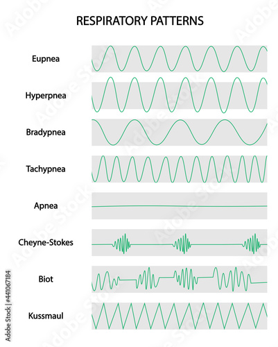 Respiratoy Patterns. Respiratory curves of different situations. Eupnea, hyperpnea, Bradypnea, Tachypnea, Apnea, Cheyne-Strokes, Biot, Kussmaul.   