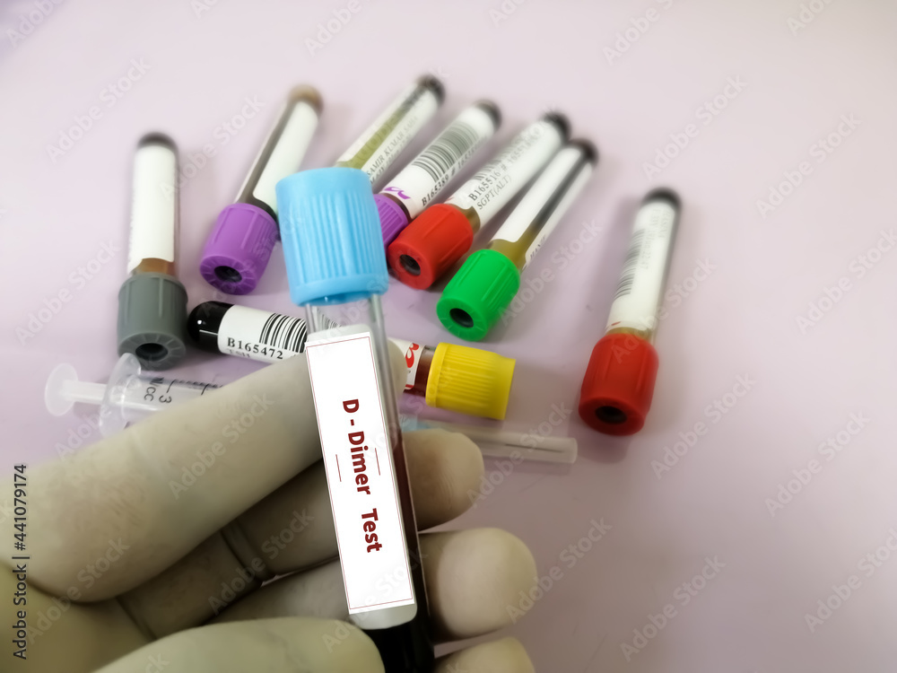 DDimer test. Corona patient monitoring test in ICU. Doctor or