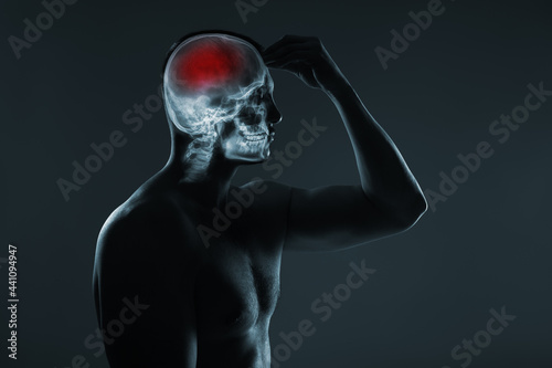 X-ray of a man's head. Cerebral stroke. Brain damage is highlighted by red colour. © hamara