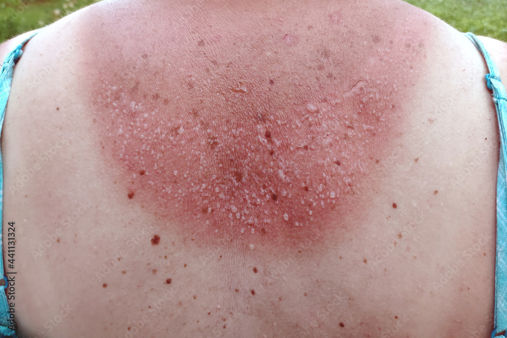 Burned skin on the back. Incorrect tanning of the body. Sun prevention concept. Burned skin on the back. Incorrect tanning of the body. Sun prevention concept.