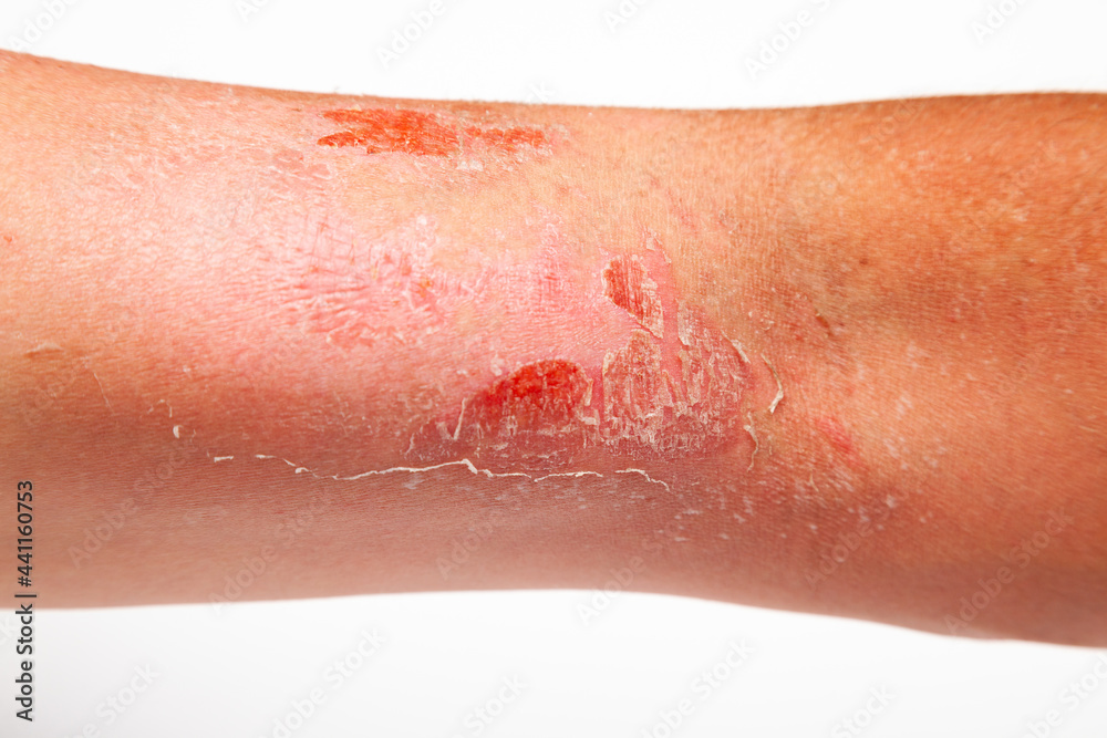 Fototapeta premium Part of a man's hand with sunburn and peeling of the skin in the bicep area on a white background.