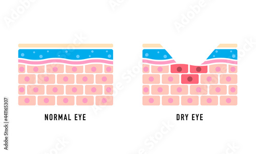 Comparison illustration between normal and dry eye.