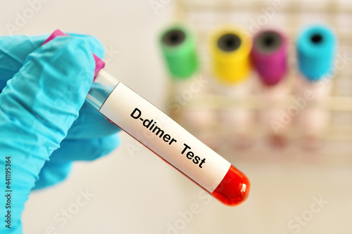 Blood sample tube for D-dimer test, diagnosis for intravascular thrombosis after COVID-19 vaccination photo