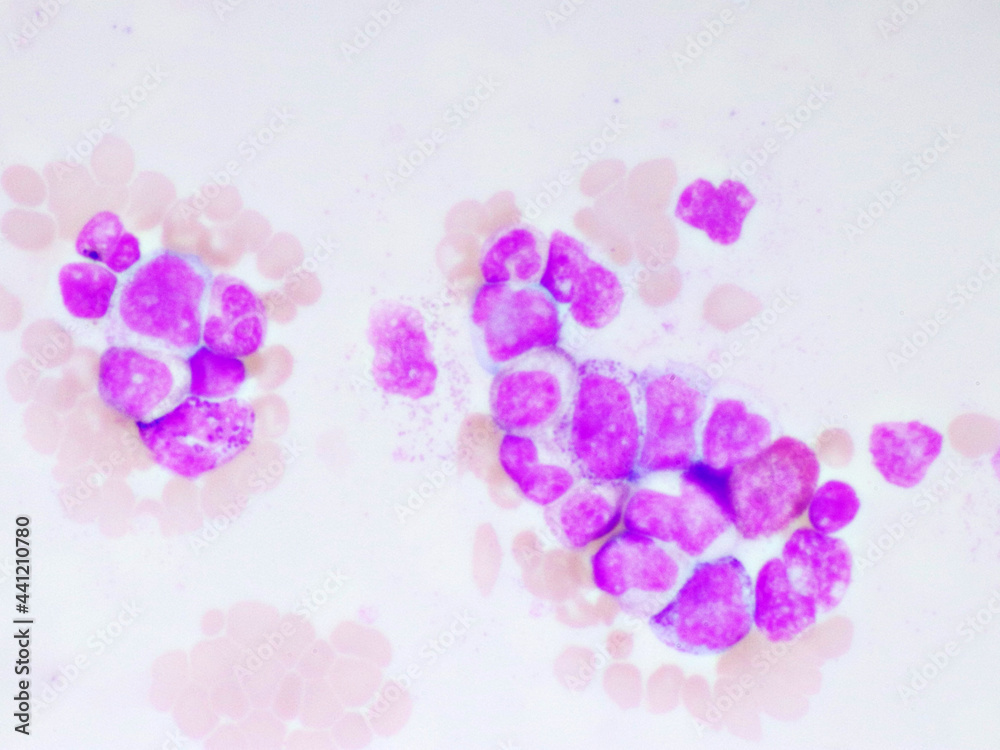 Chronic myeloid leukemia cells or CML, analyze by microscope, original magnification 1000x