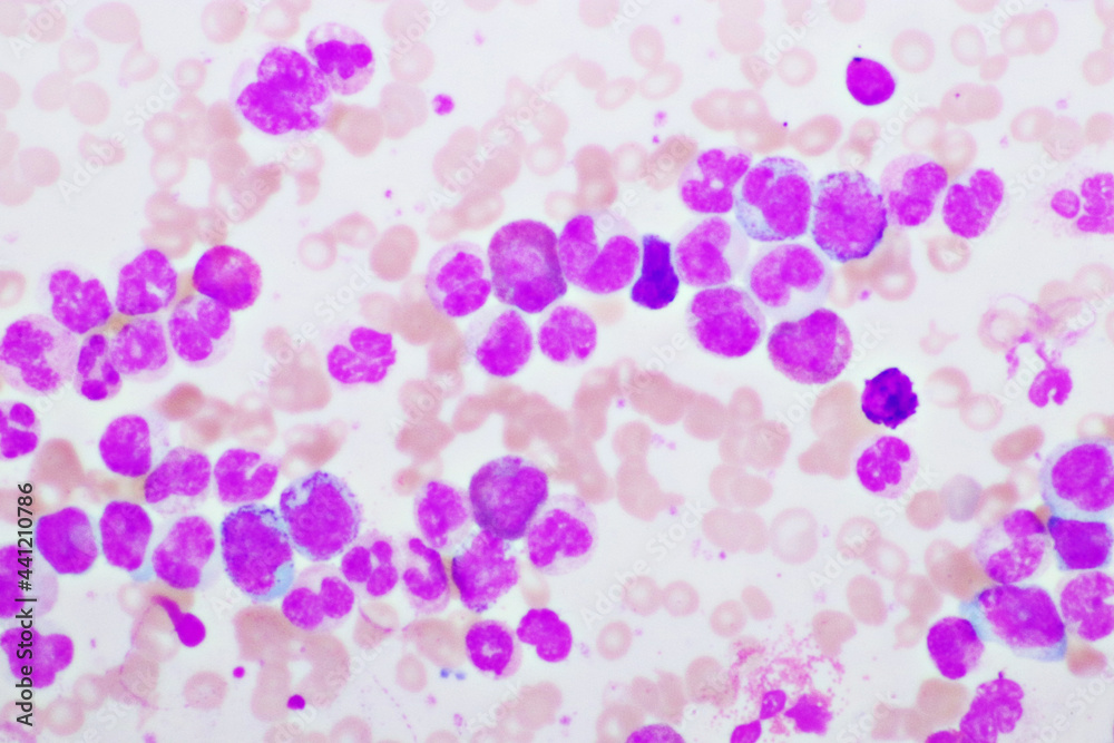 Chronic myeloid leukemia cells or CML, analyze by microscope, original magnification 400x