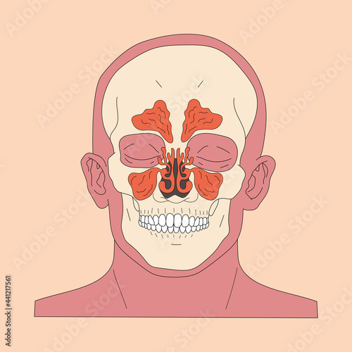 Sinusitis, rhinosinusitis. Vector illustration in flat style.