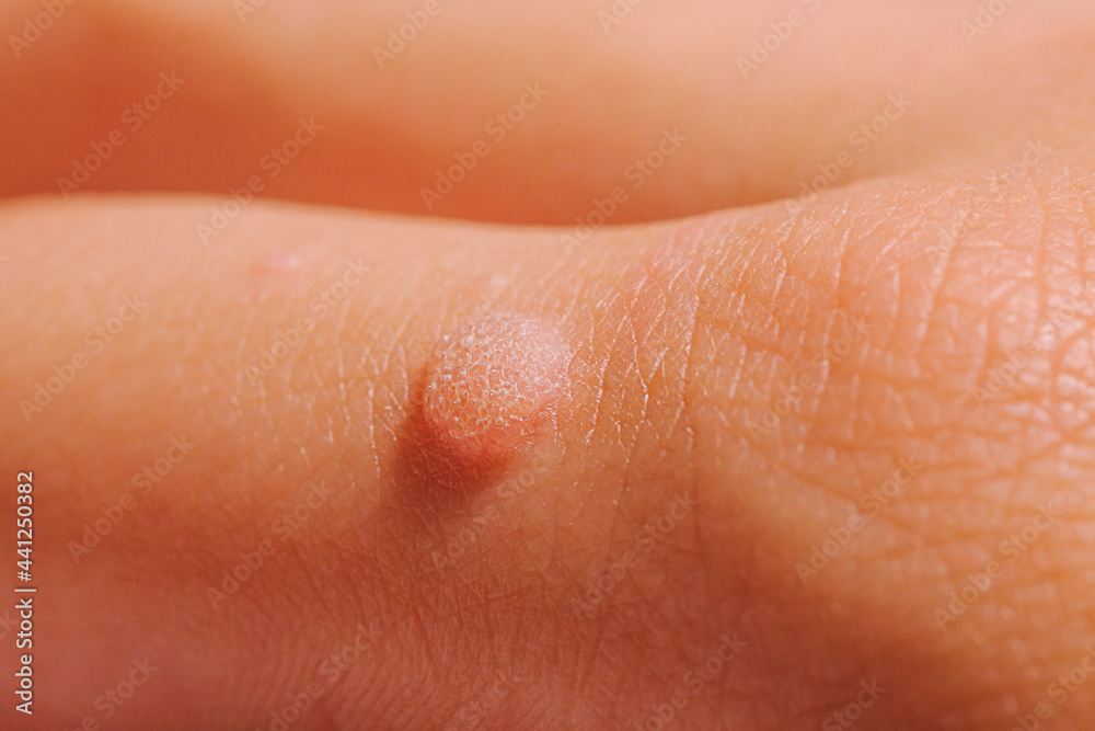 Common wart Verruca vulgaris a flat wart commonly found on the hand of children and adults. They are caused by a type of human papillomavirus HPV. Common wart Verruca vulgaris a flat wart commonly found on the hand of children and adults. They are caused by a type of human papillomavirus HPV.